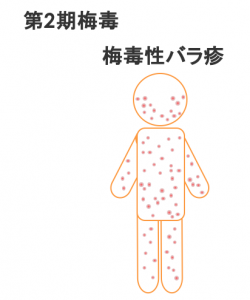 第二期梅毒　梅毒性バラ疹