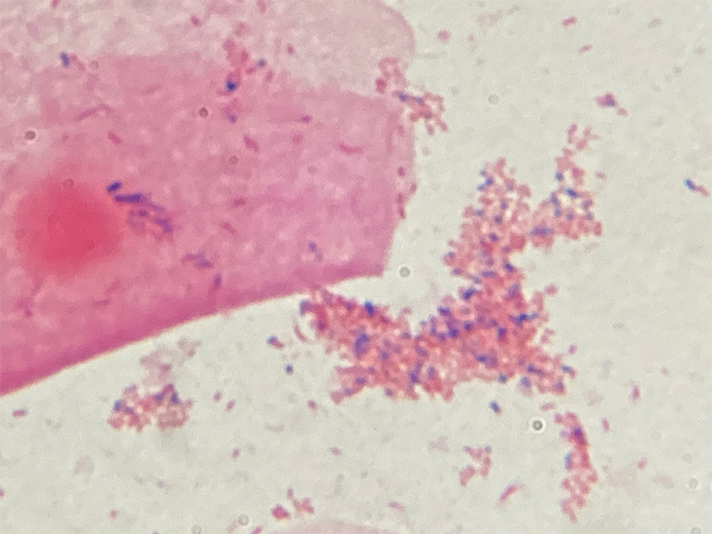 細菌性膣症の初期段階