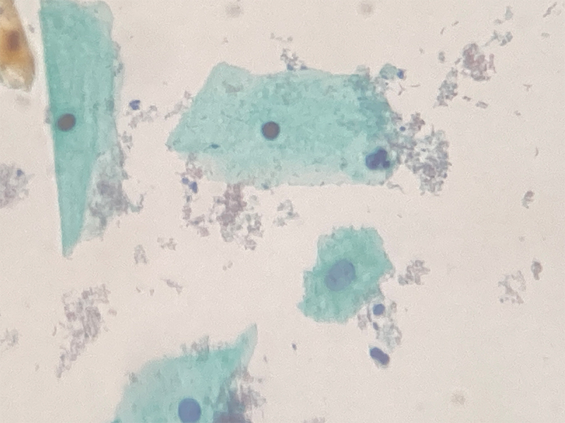 細菌性膣症の初期段階