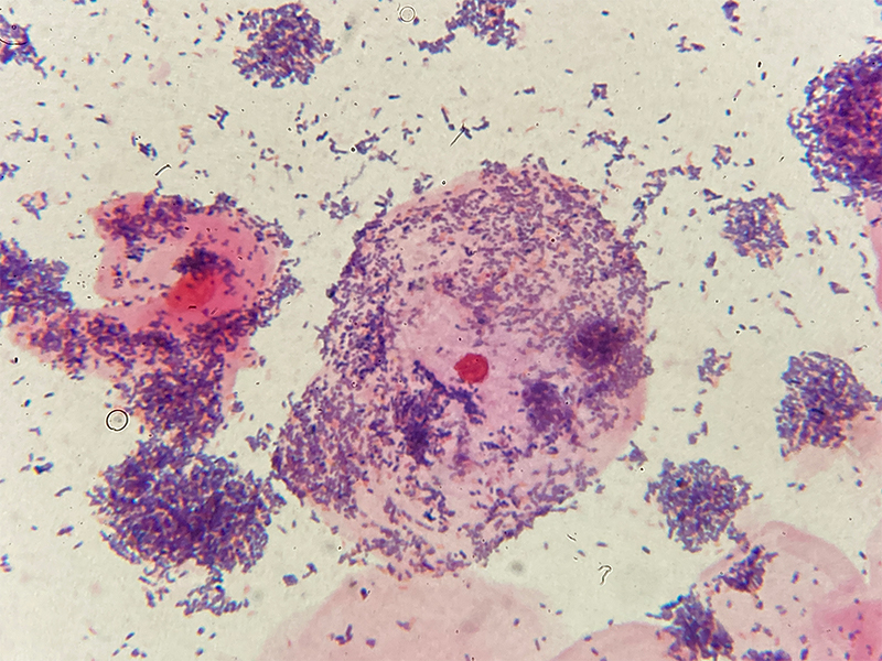 細菌性膣症の写真