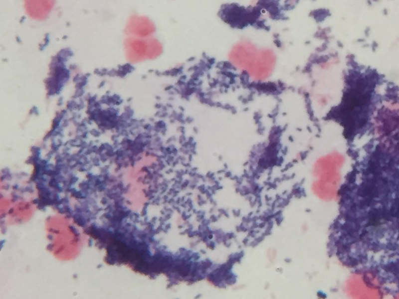 炎症を伴う細菌性膣症