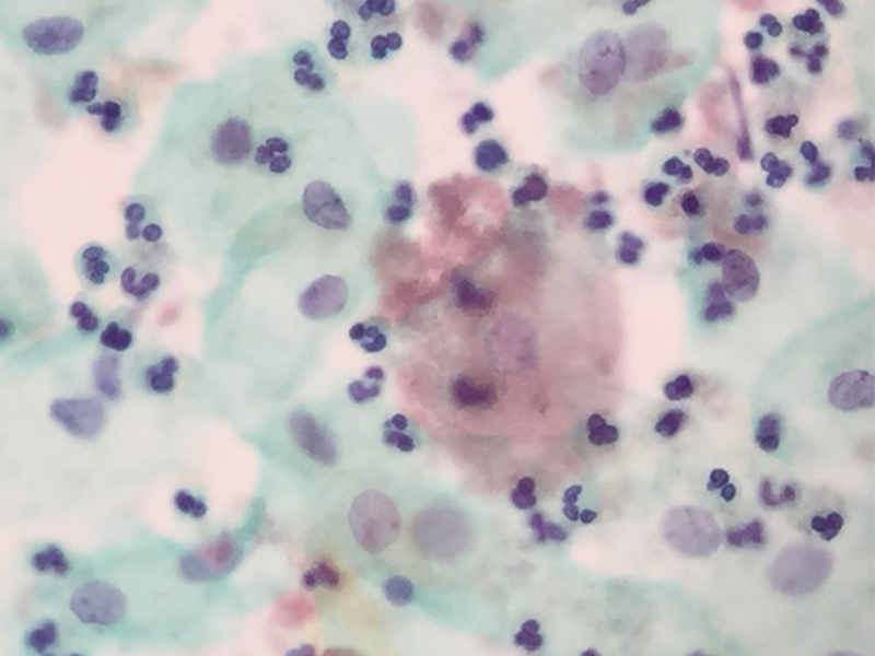 炎症を伴う細菌性膣症