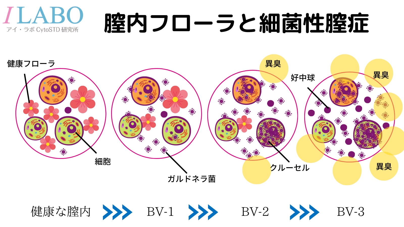 細菌性膣症 子宮頸がん Std検査のアイラボ 東京都 八王子市