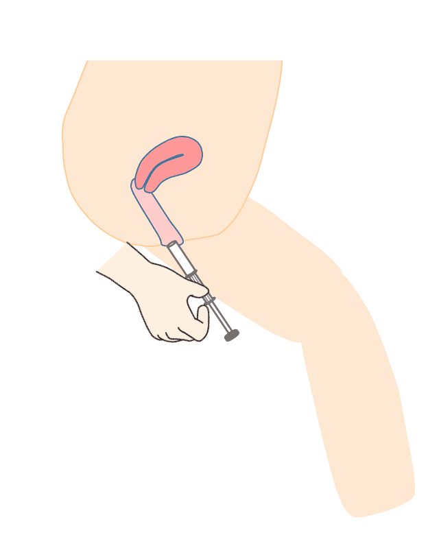 採取器具の取り出し